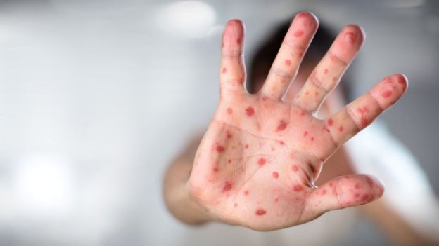It was reported that cases of measles infection from foreigners have increased in Uzbekistan