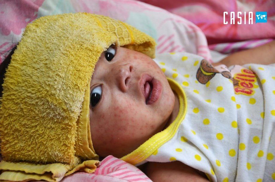 Qirg‘izistonda uch nafar bola qizamiqdan vafot etdi