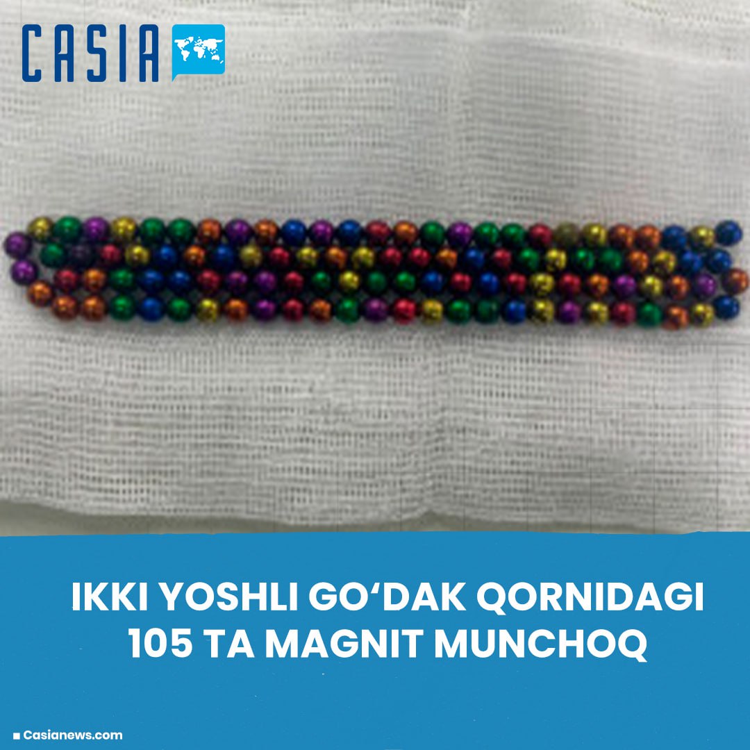 105 magnetic beads removed from stomach of two-year-old boy in Kazakhstan