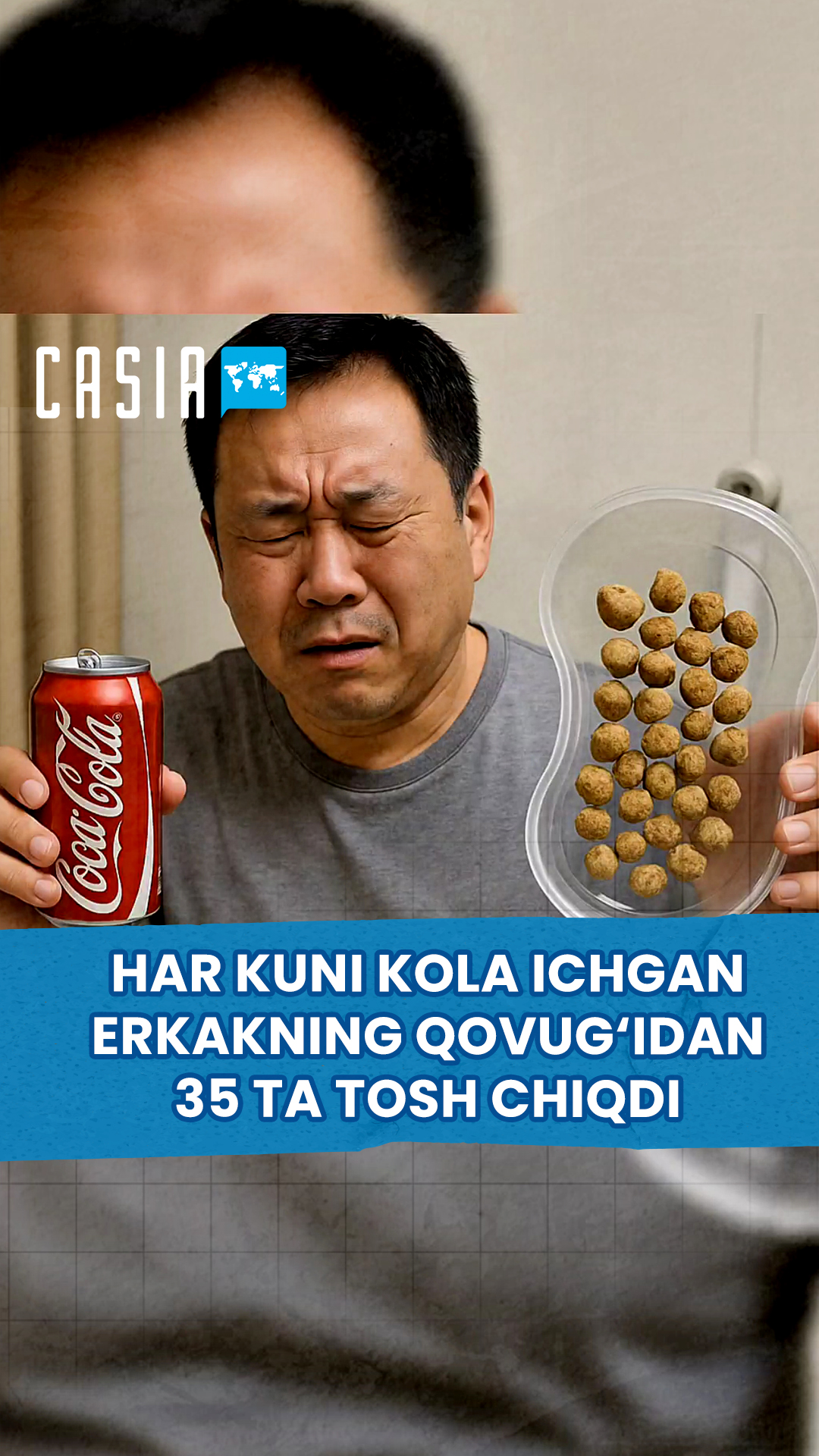Man who drank cola every day had 35 large stones removed from his bladder