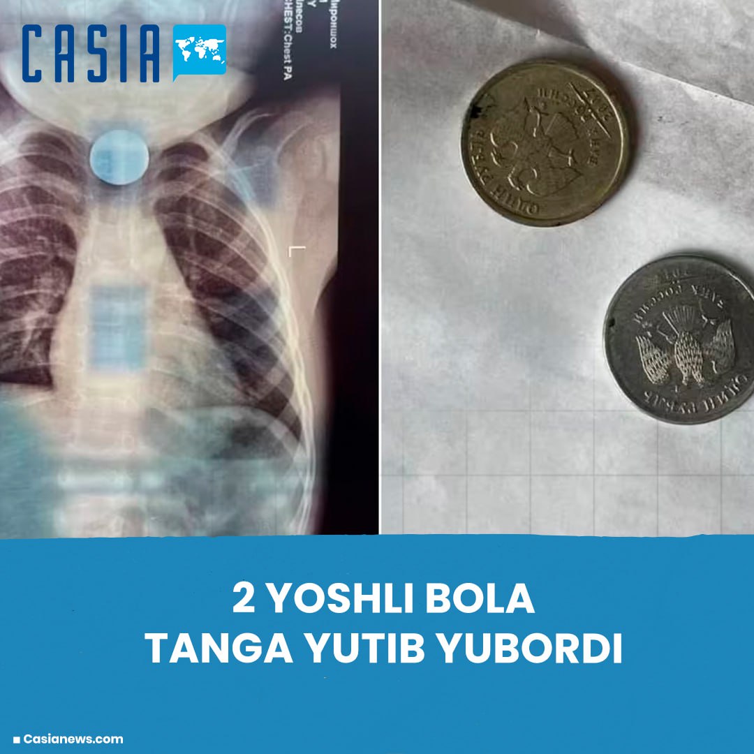 2-year-old boy swallows coin in Bukhara