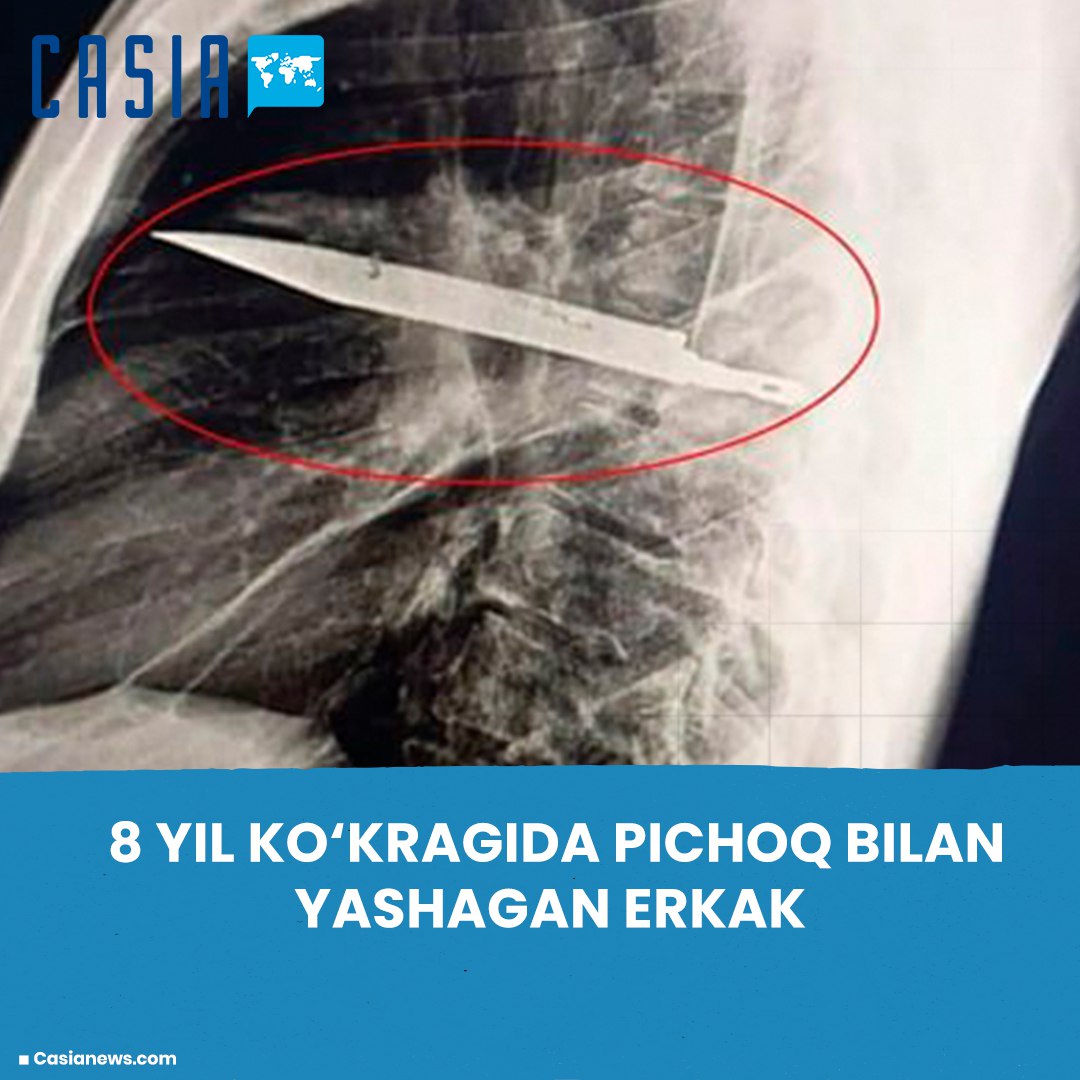 Tanzanian man lived with a knife in his chest for 8 years