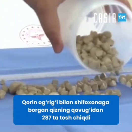 287 stones were removed from a patient who came to the hospital with abdominal pain