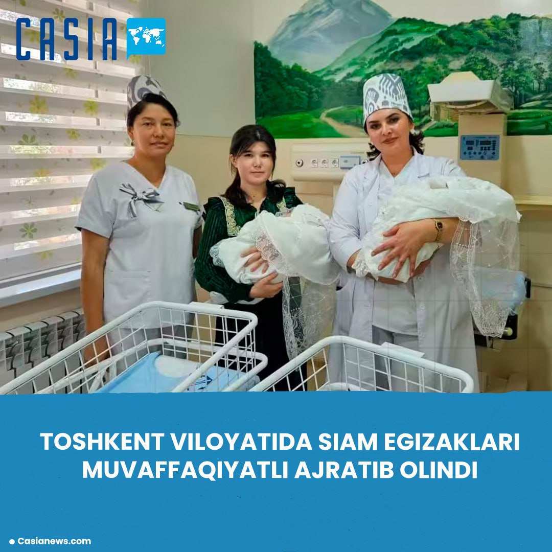 Conjoined twins successfully separated in Tashkent region