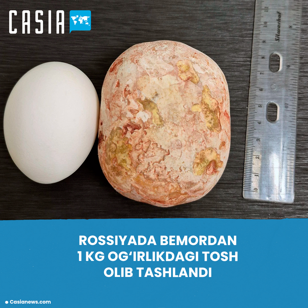A 1kg stone was removed from a patient in Russia