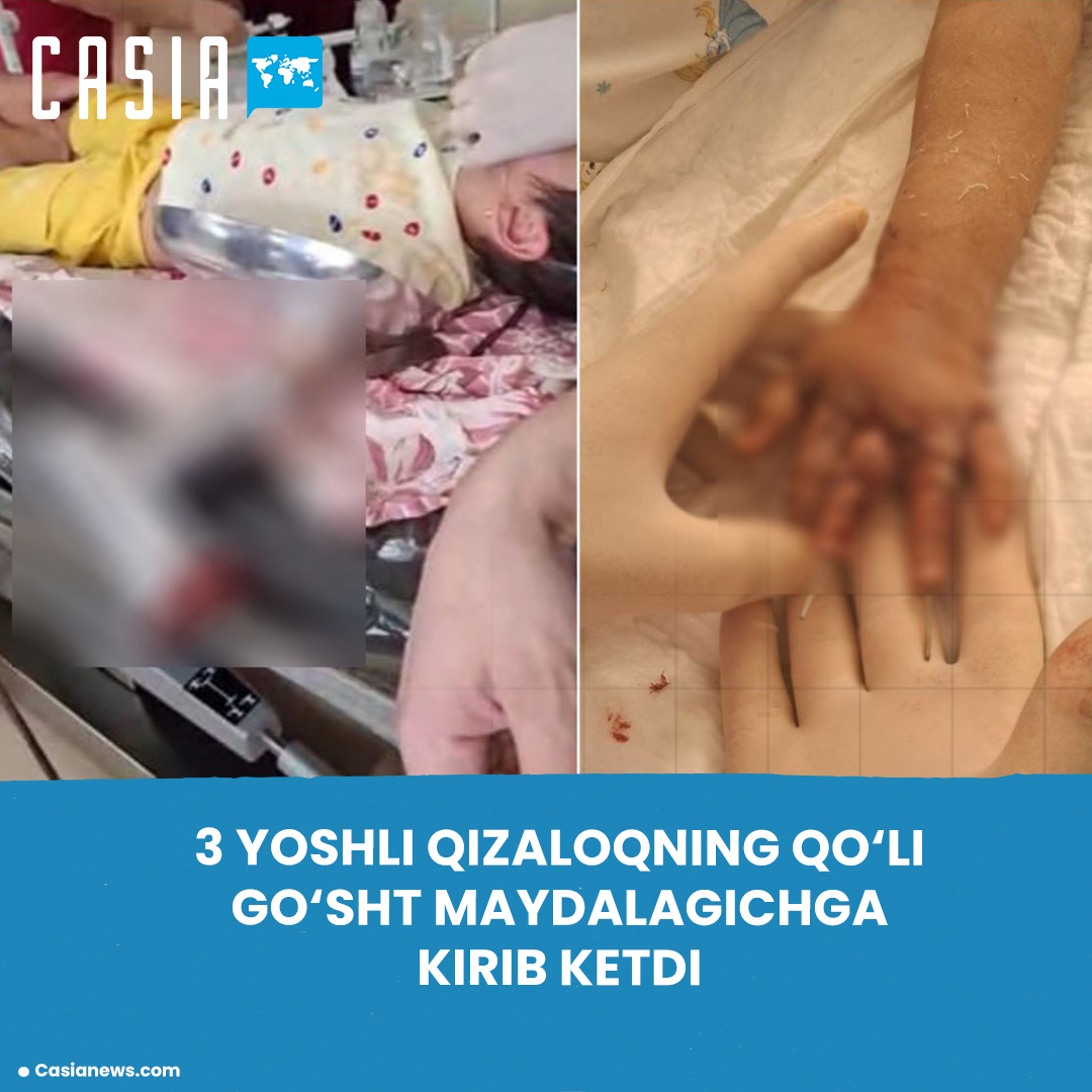 A 3-year-old girl’s hand got caught in a meat grinder 