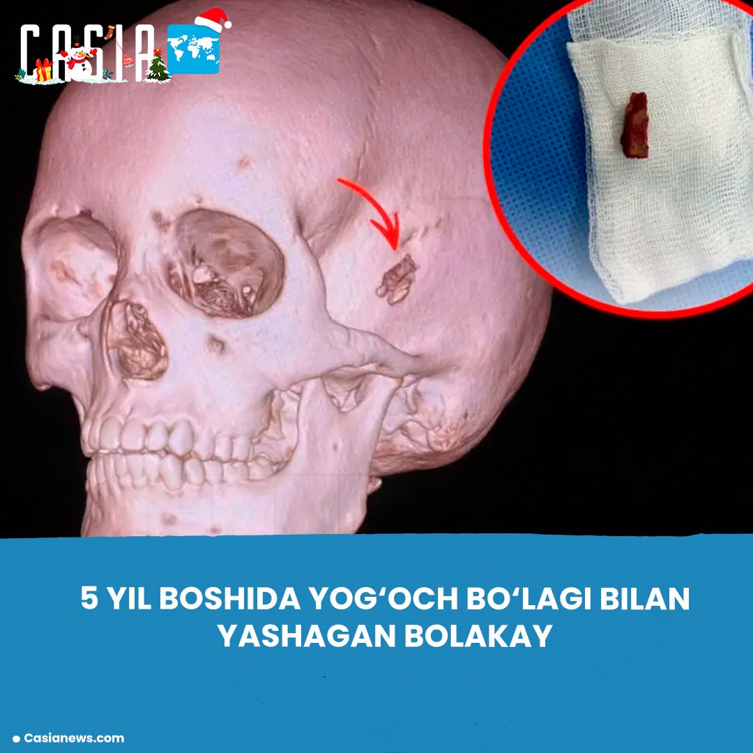In Kazakhstan, a 10-year-old boy lived for five years with a piece of wood in his head