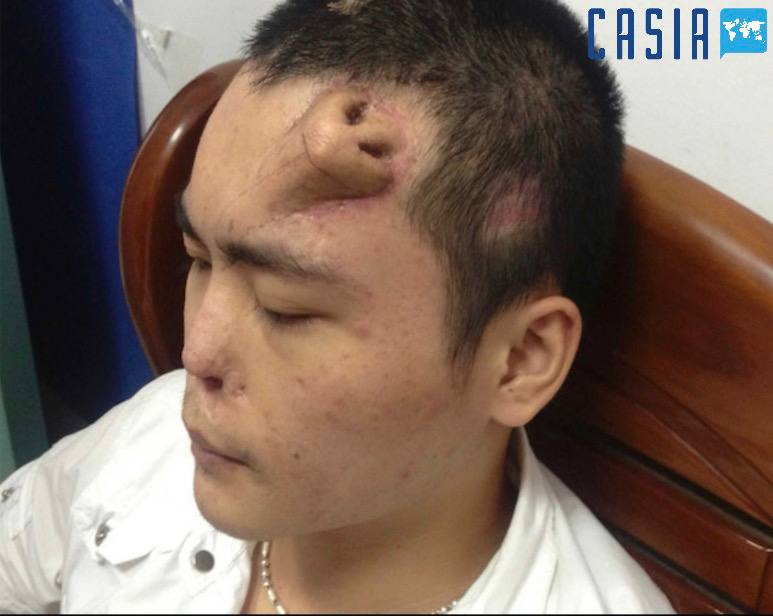 Nose transplanted in a bed: the amazing experience of Chinese doctors 