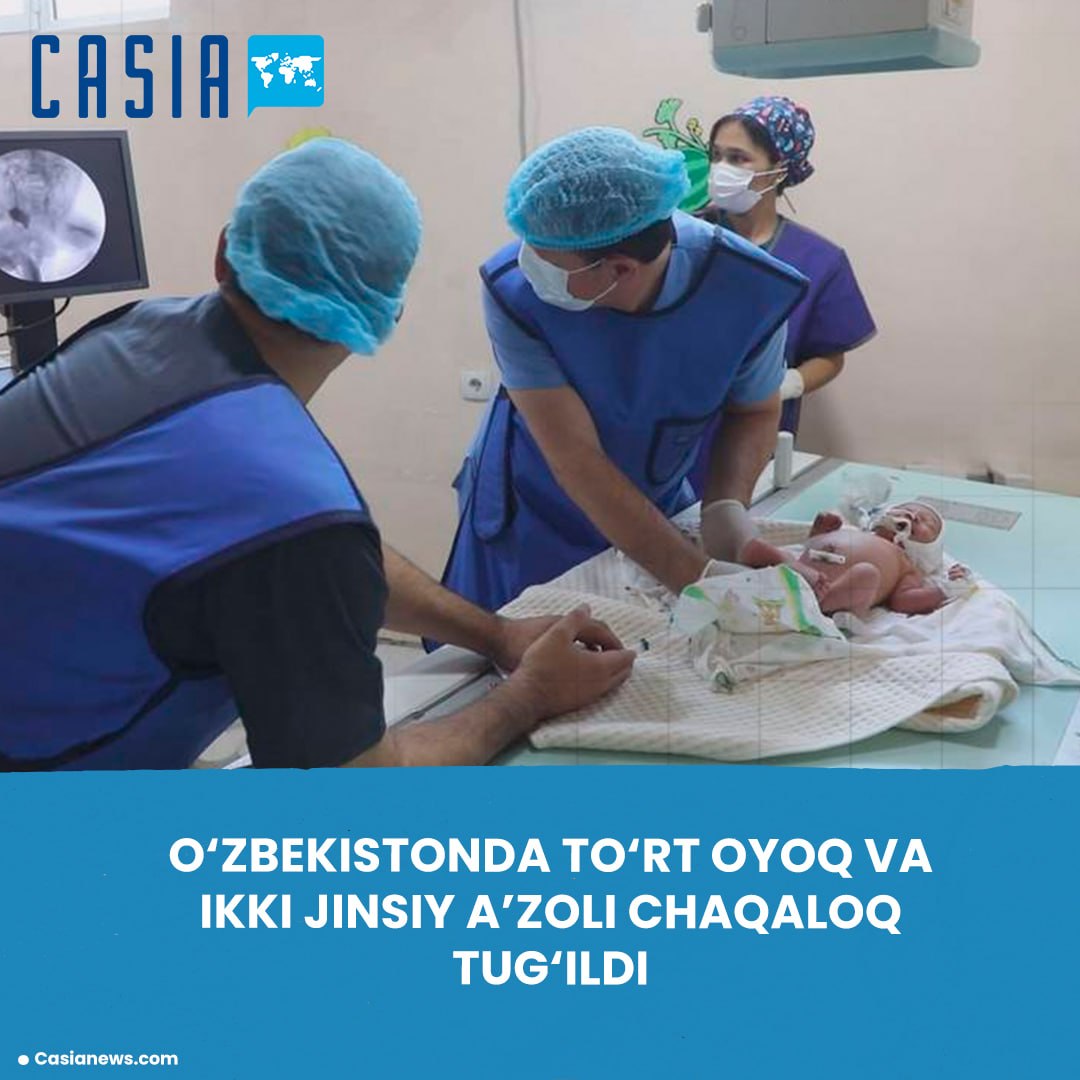 A baby with a rare birth defect was born in Surkhandarya