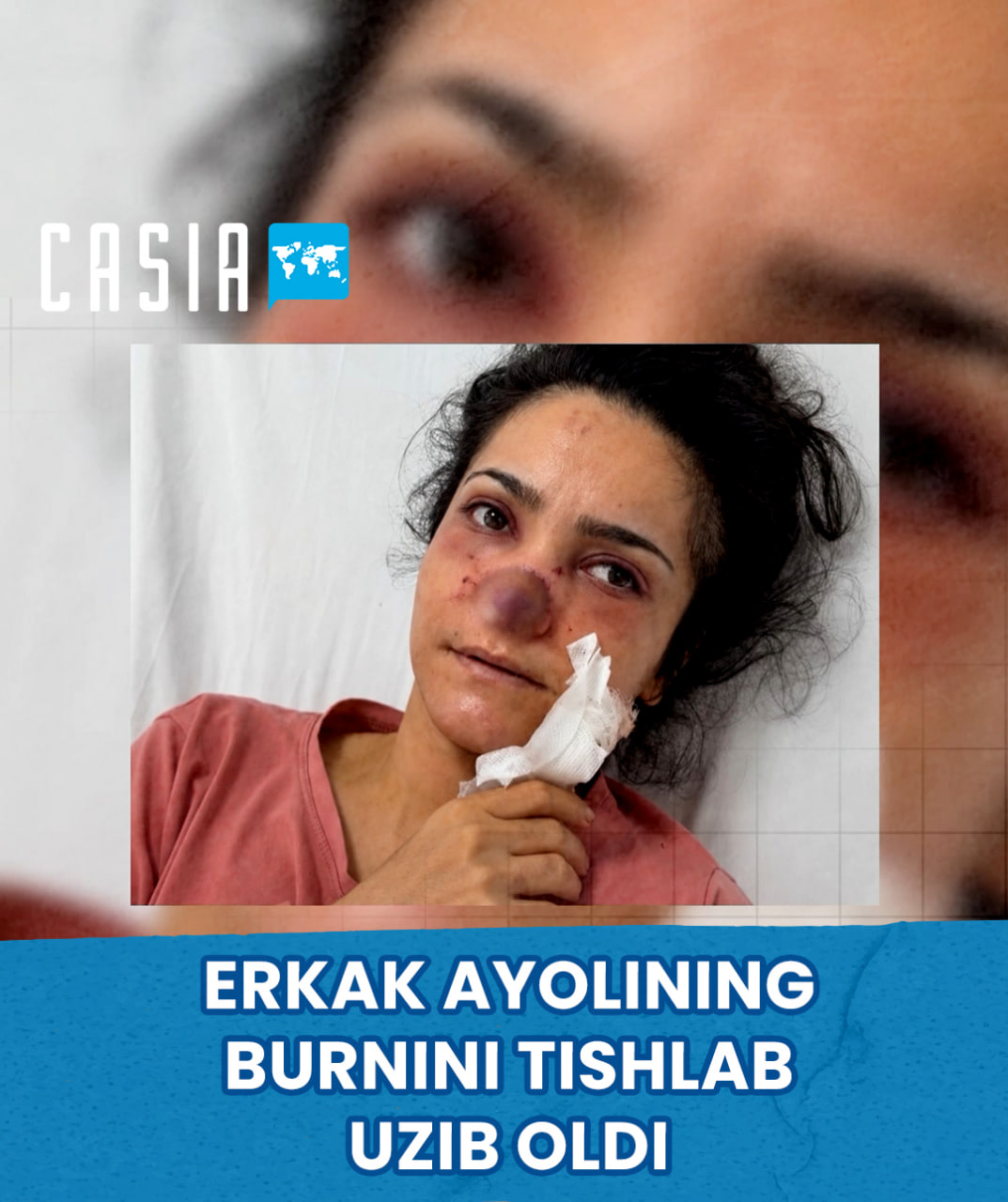 Man in Turkey bites off wife’s nose
